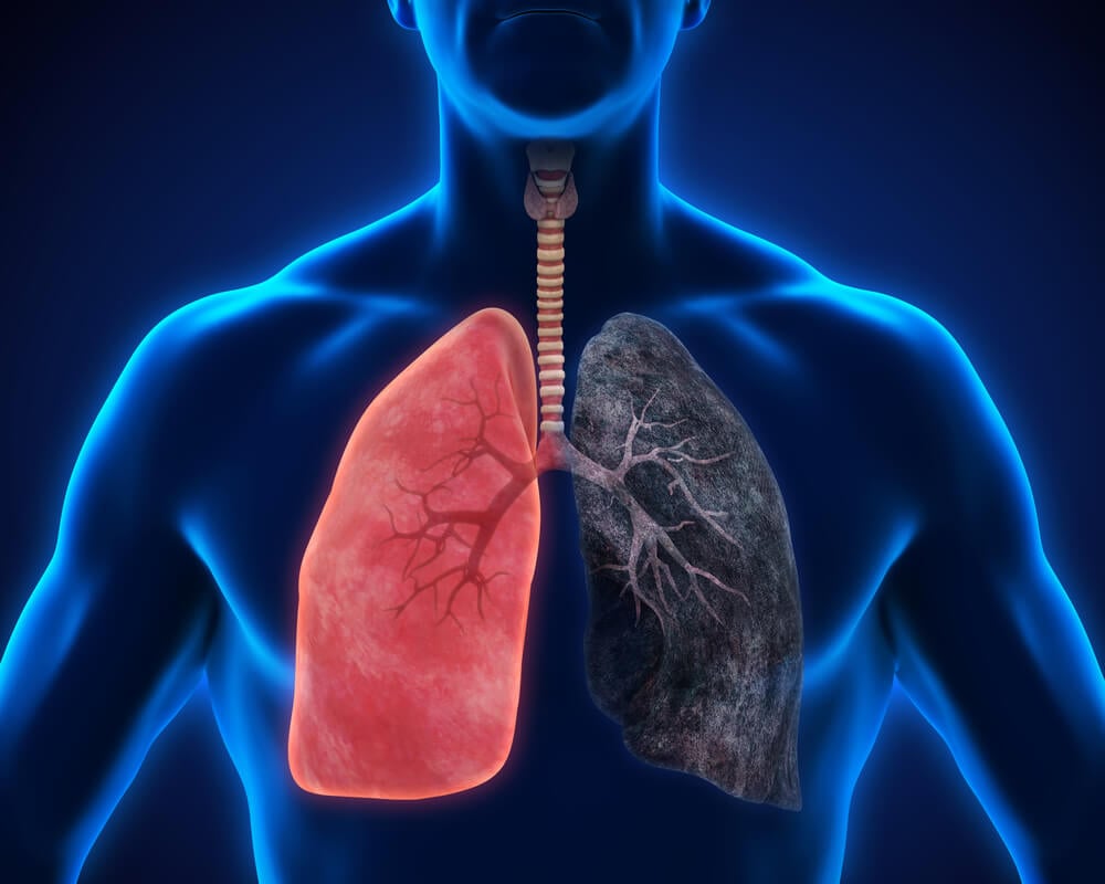Pulmones de un fumador | NICORETTE®